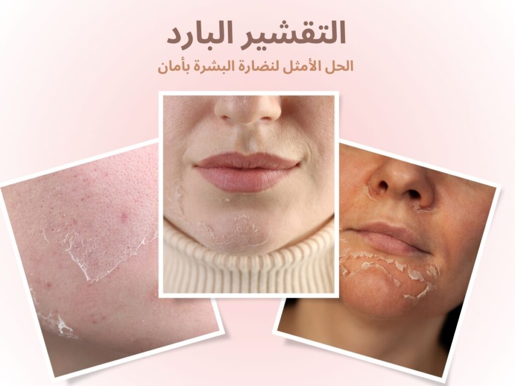 التقشير البارد: الحل الأمثل لنضارة البشرة بأمان Cold Peeling: The Perfect Solution for Safe Skin Freshness