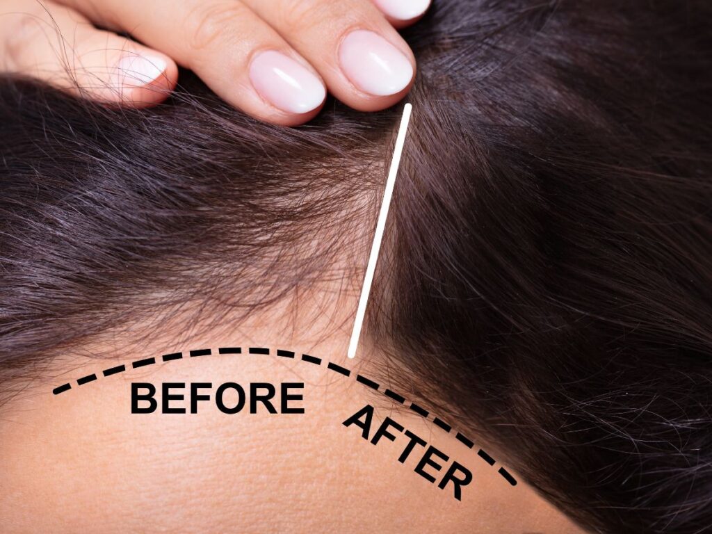 بلازما الشعر: هل هي الحل الأمثل لتساقط الشعر؟ كل ما يجب معرفته Hair Plasma: Is It the Best Solution for Hair Loss? Everything You Need to Know